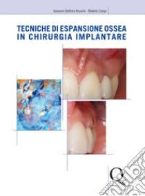 Tecniche di espansione ossea in chirurgia implantare libro di Bruschi Giovanni Battista; Crespi Roberto