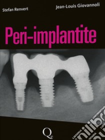 Peri-implantite libro di Renvert Stefan; Giovannoli Jean-Louis