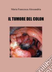 Il tumore del colon libro di Alessandria Maria Francesca