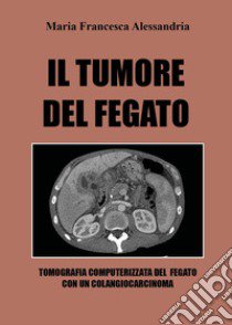 Il tumore del fegato libro di Alessandria Maria Francesca